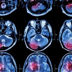 scan of a brain